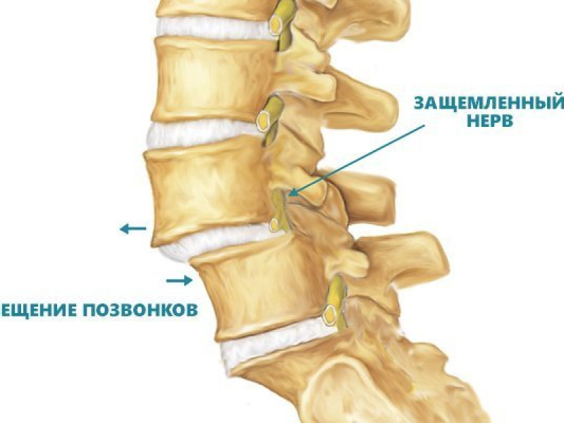 Захворювання хребта. Частина 2