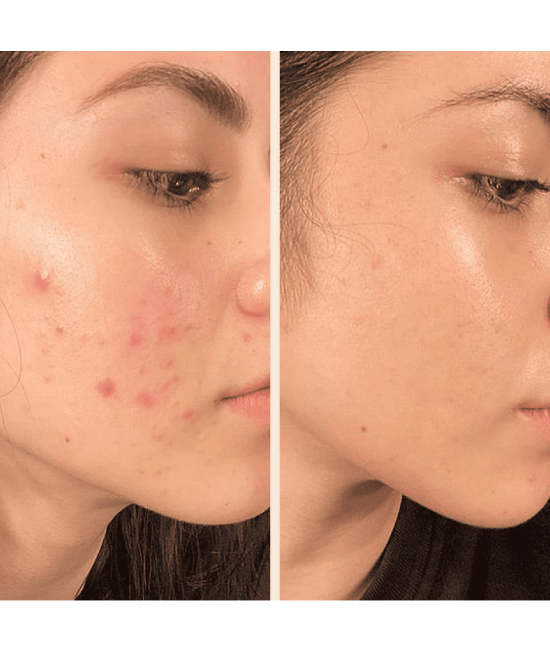 Портативний дарсонваль MEDICA+ DARSOLINE 7.0 - 10